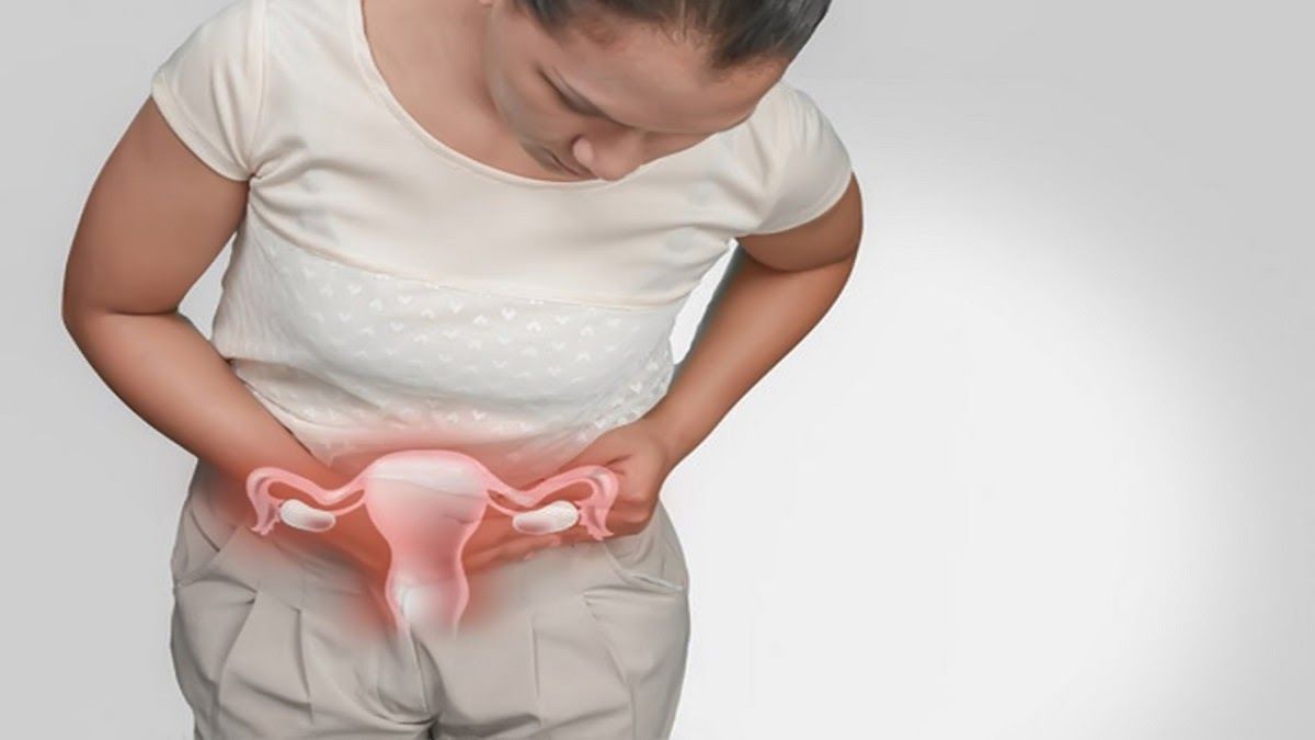 Ung thư buồng trứng giai đoạn 3 được chia thành 3 giai đoạn nhỏ