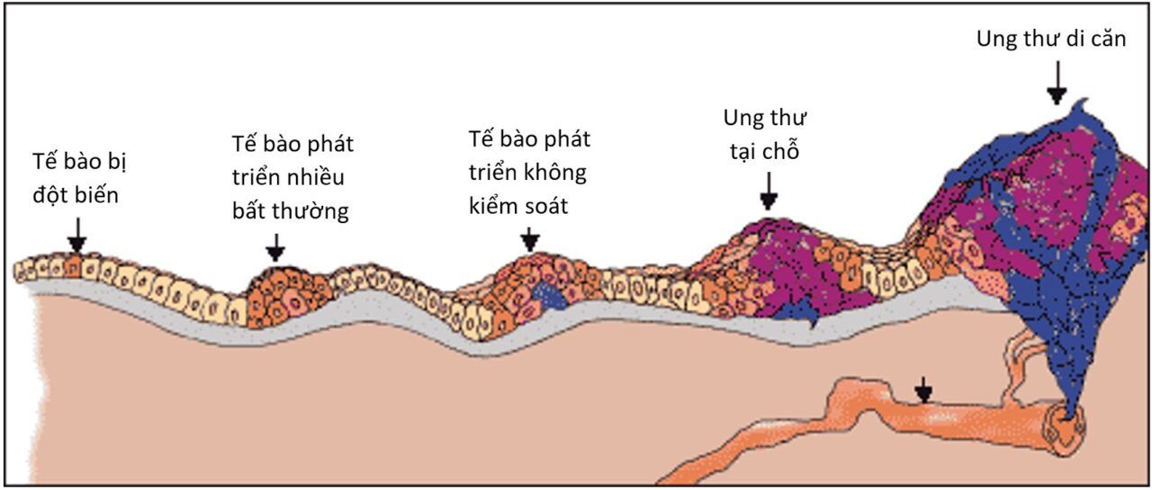 Một số tế bào có thể tách ra và đi vào các mạch bạch huyết nhỏ hoặc các mạch máu, hay còn được gọi là mao mạch, trong khu vực.