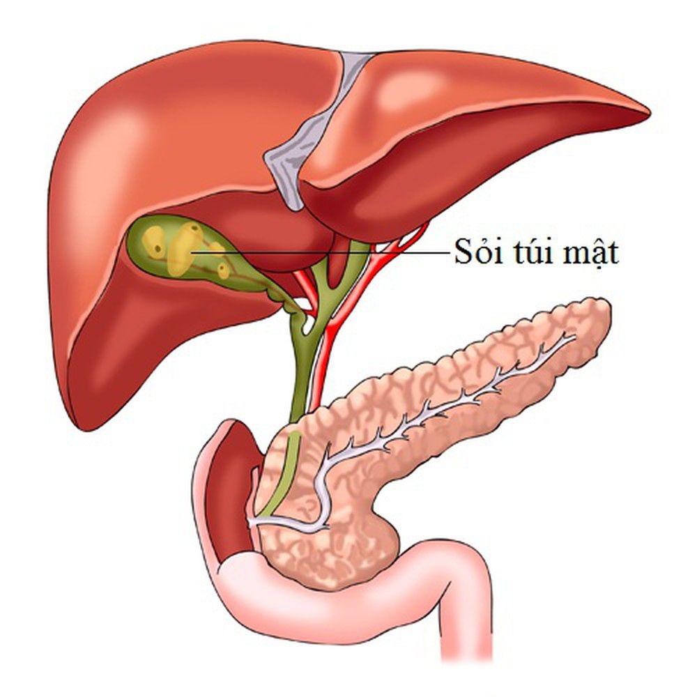 Sỏi túi mật là yếu tố có thể gây ra ung thư túi mật