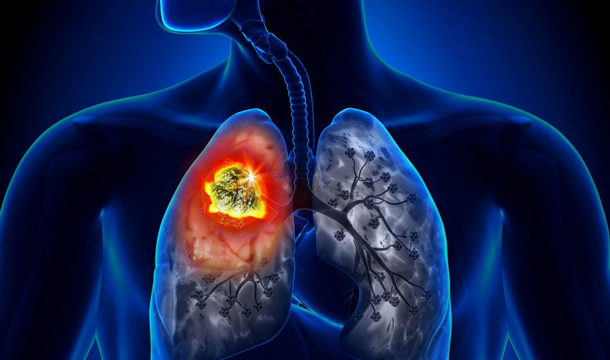 Nhiễm khí radon là một nguyên nhân gây nên bệnh ung thư phổi