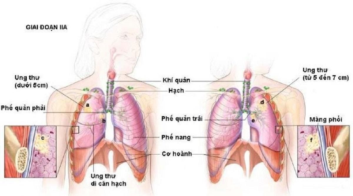 Ung thư phổi giai đoạn cuối có khả năng di căn đến gan, não, tuyến thượng thận, xương…