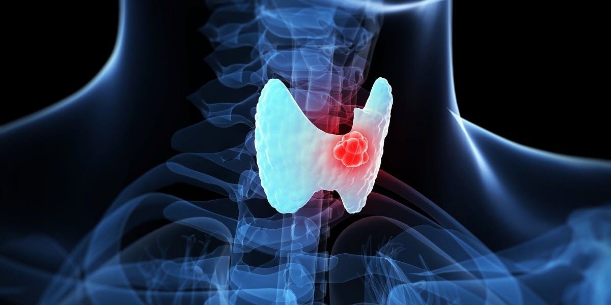 Căn bệnh ung thư tuyến giáp đang ngày càng tăng nhưng tỷ lệ chữa khỏi bệnh cũng cao