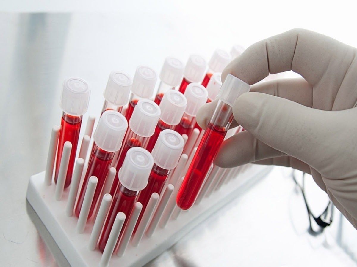 Xét nghiệm máu giúp chẩn đoán ung thư tuyến tiền liệt