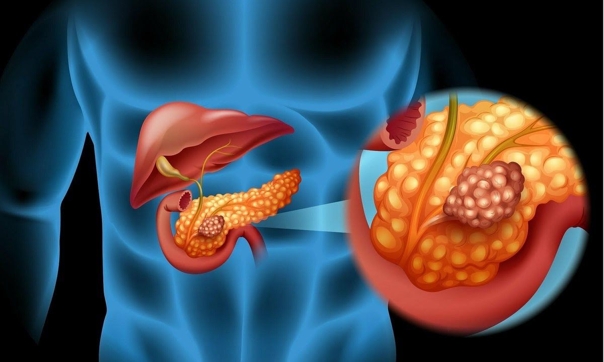 Hút thuốc lá, bệnh tiểu đường, viêm tụy... là những yếu tố nguy cơ gây ung thư tuyến tụy