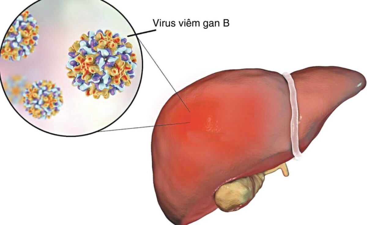 Virus viêm gan B gây nên bệnh ung thư gan