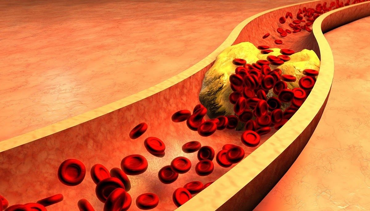 Mỡ máu cao là tình trạng rối loạn lipid máu