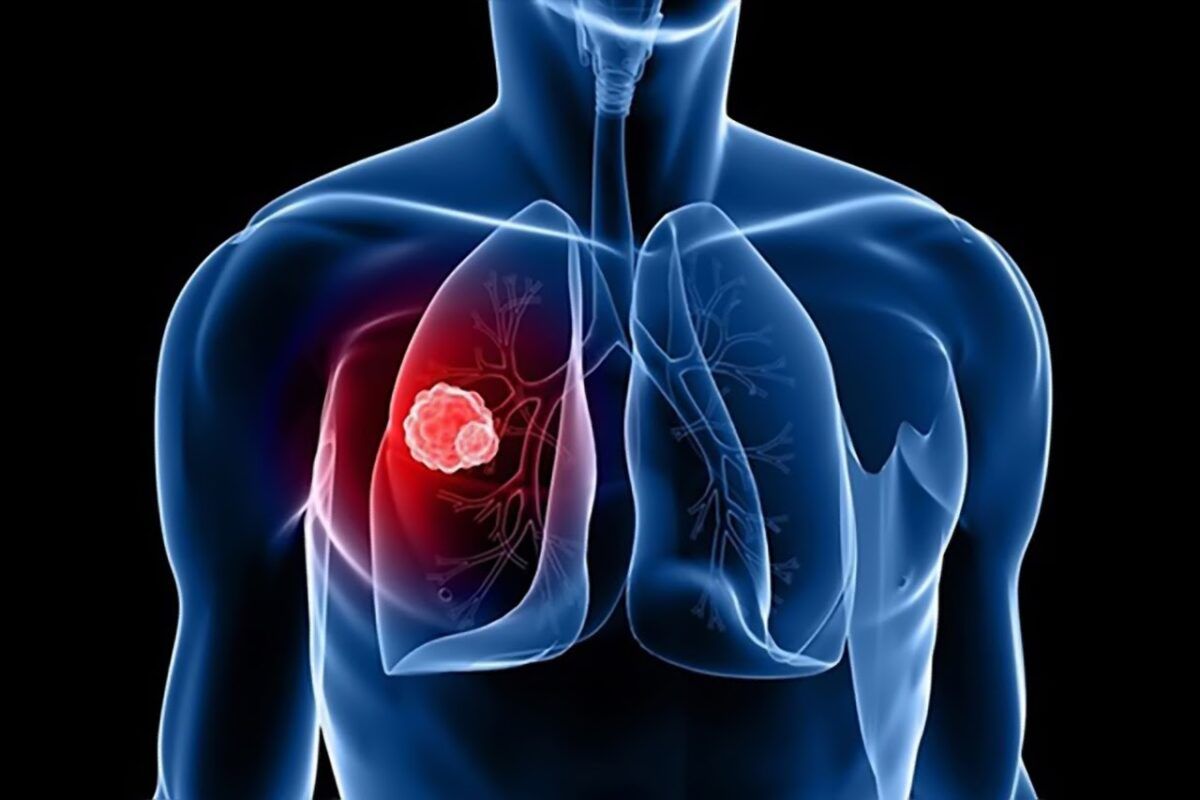 Ung thư phổi ở giai đoạn đầu khối u còn rất nhỏ chưa xâm lấn