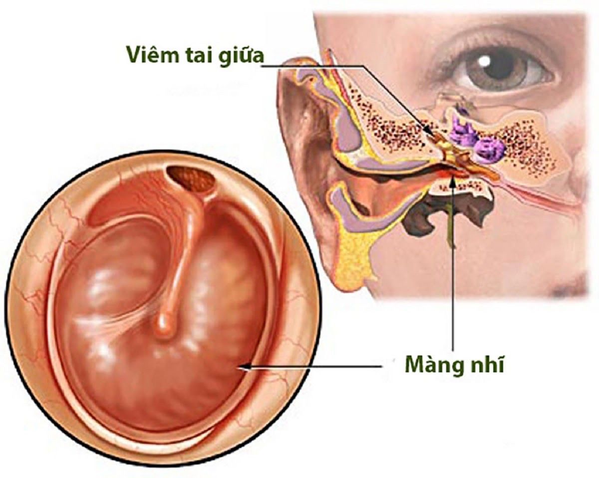 Viêm tai giữa ở trẻ là hiện tượng trẻ bị nhiễm trùng ở tai giữa