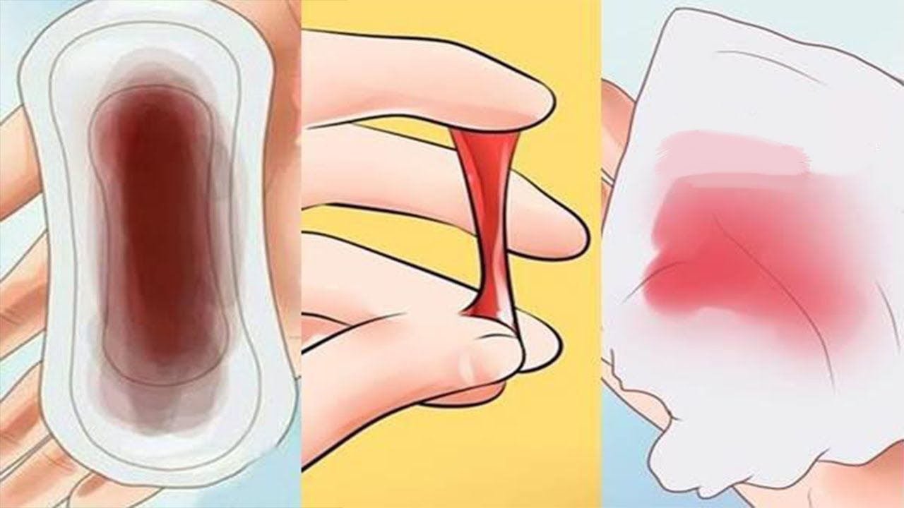 Cách nhận biết ung thư cổ tử cung qua dấu hiệu chảy máu âm đạo