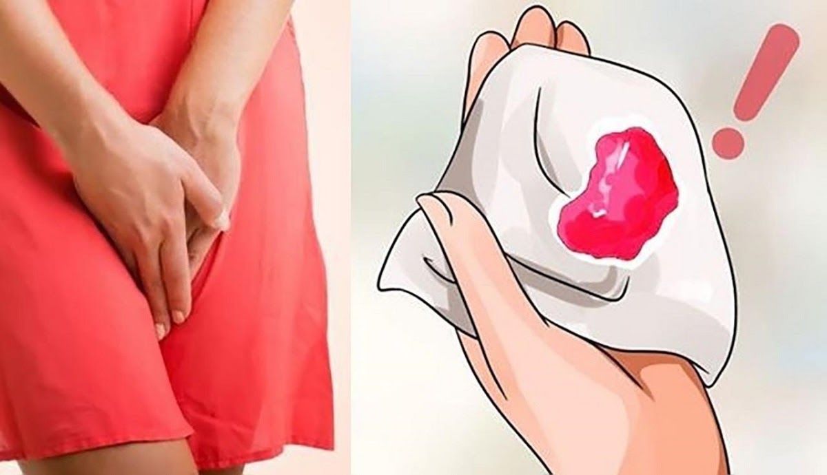 Xuất huyết âm đạo bất thường là dấu hiệu bệnh ung thư cổ tử cung