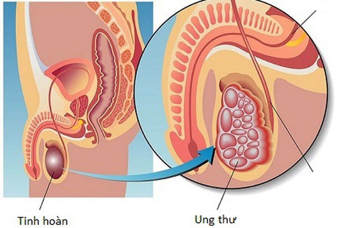 Xuất hiện khối u trong tinh hoàn là dấu hiệu ung thư tinh hoàn điển hình