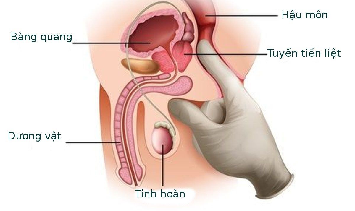 Hình ảnh mô tả ung thư tuyến tiền liệt ở nam giới