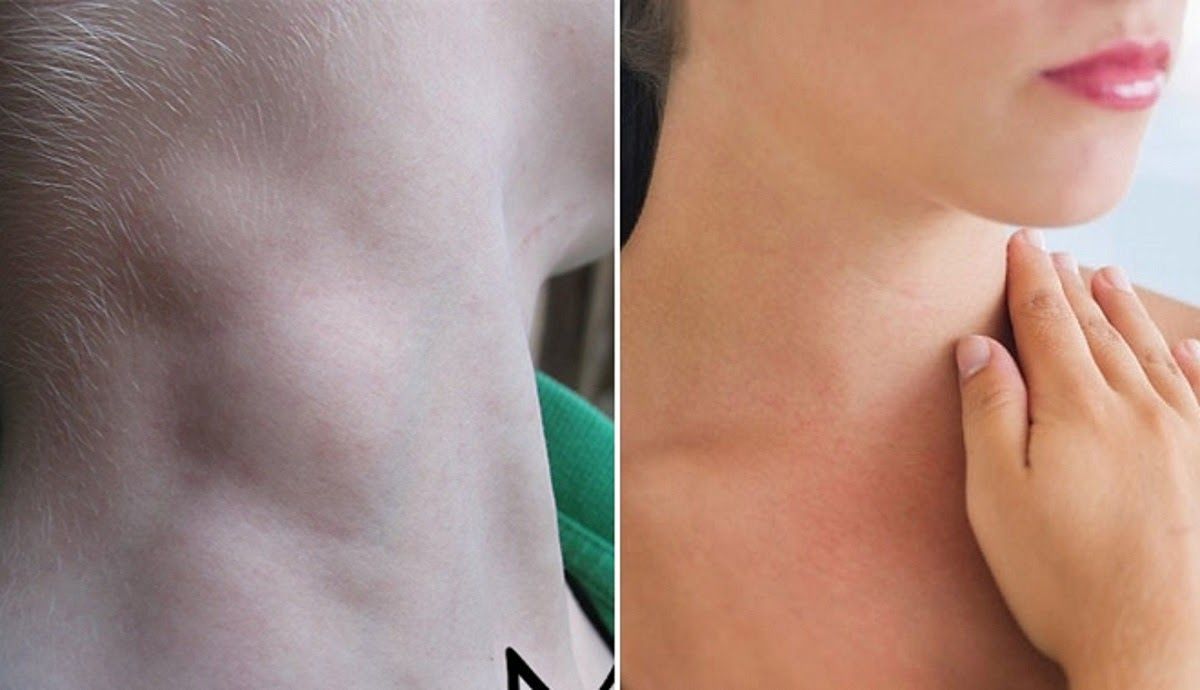 Nổi hạch ở cổ là một trong những dấu hiệu ung thư vòm họng sớm