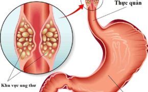 Ung thư thực quản có lây không?