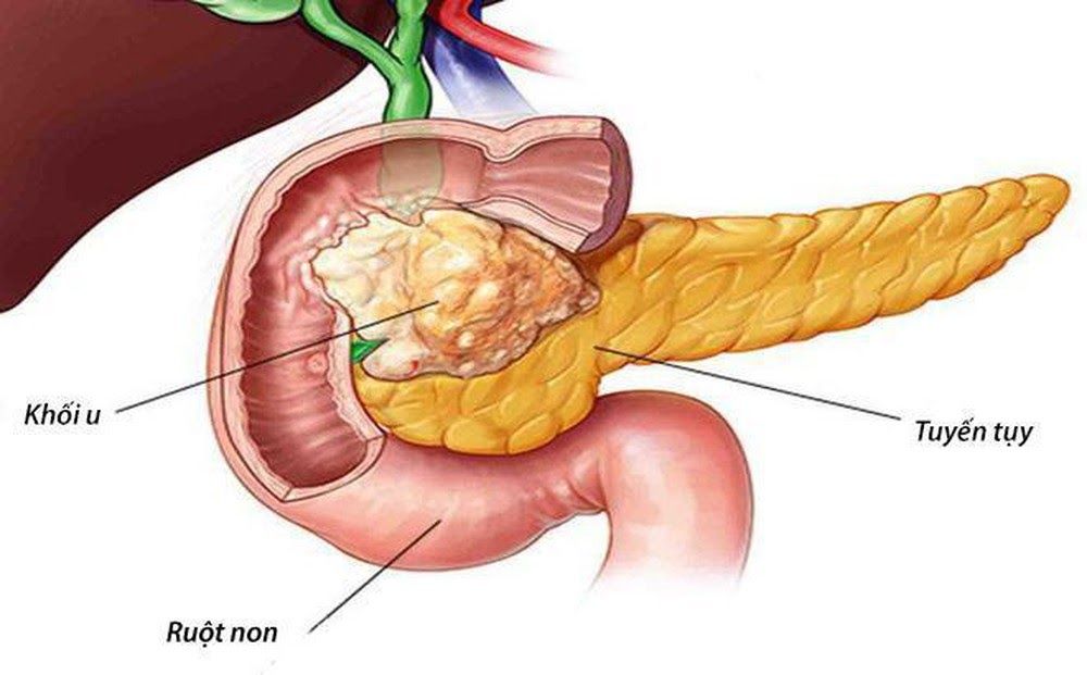 Ung thư tuyến tụy thường có tỷ lệ tỷ vong cao