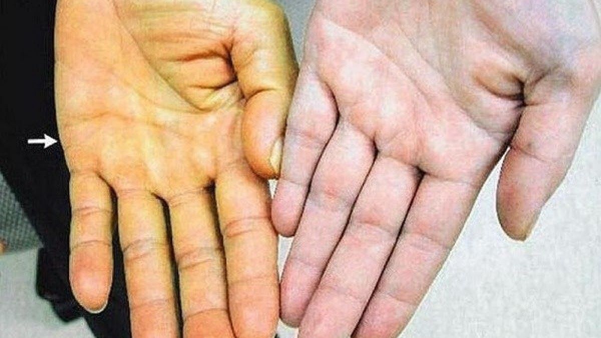 Vàng da là triệu chứng biểu hiện dễ nhận biết của ung thư gan