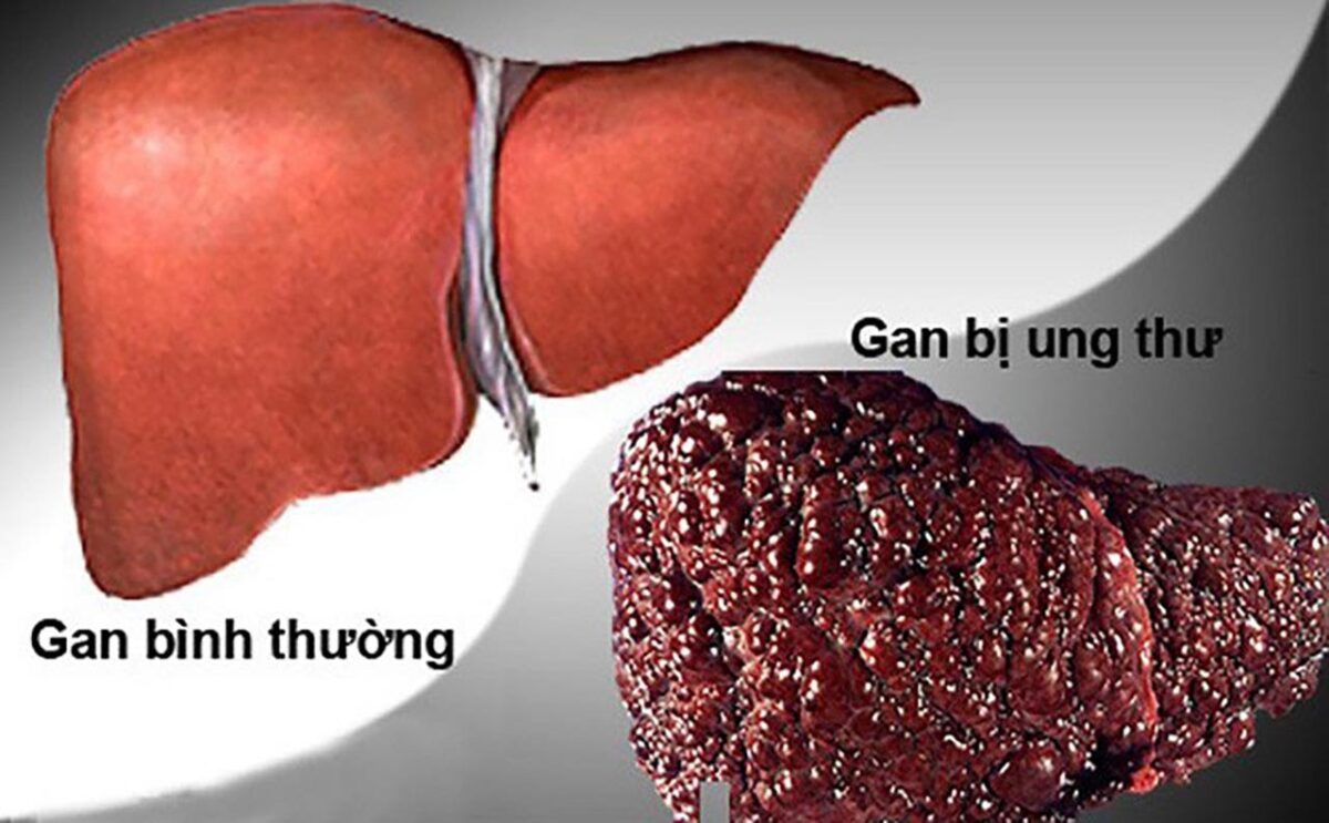 Hình ảnh một lá gan bình thường và một lá gan khi bị ung thư