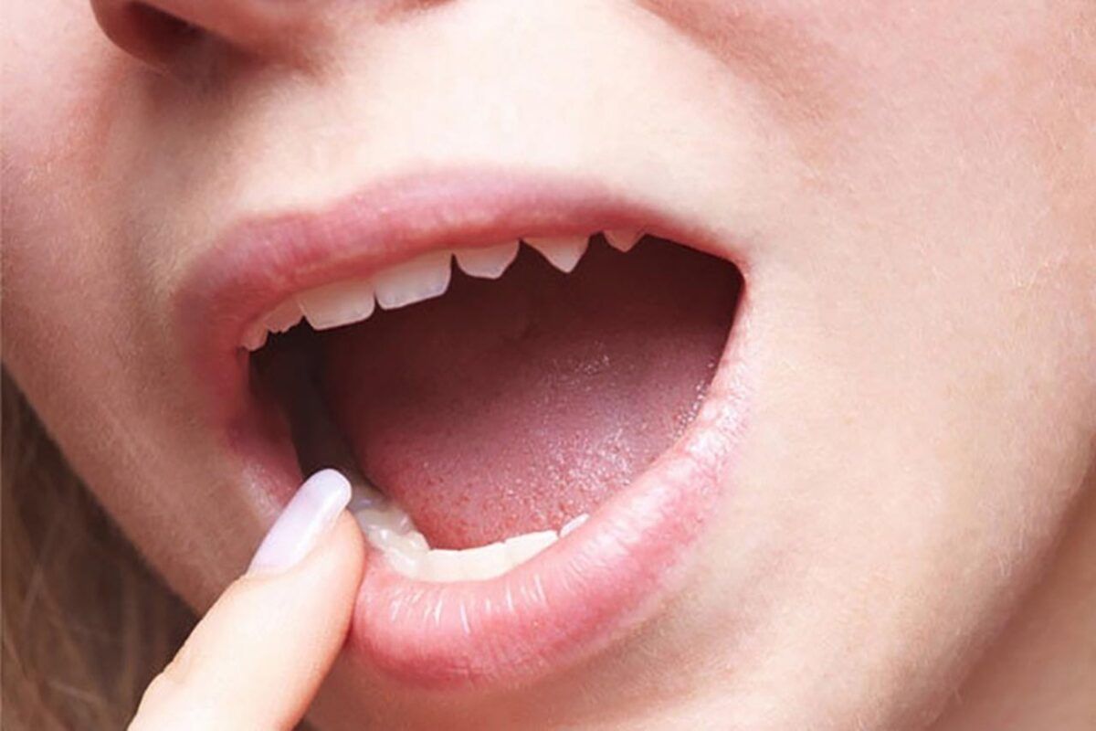 Ở giai đoạn đầu của bệnh, bệnh nhân không cảm thấy đau đớn, nếu có thì đó chỉ là một vị trí nào đó trong miệng