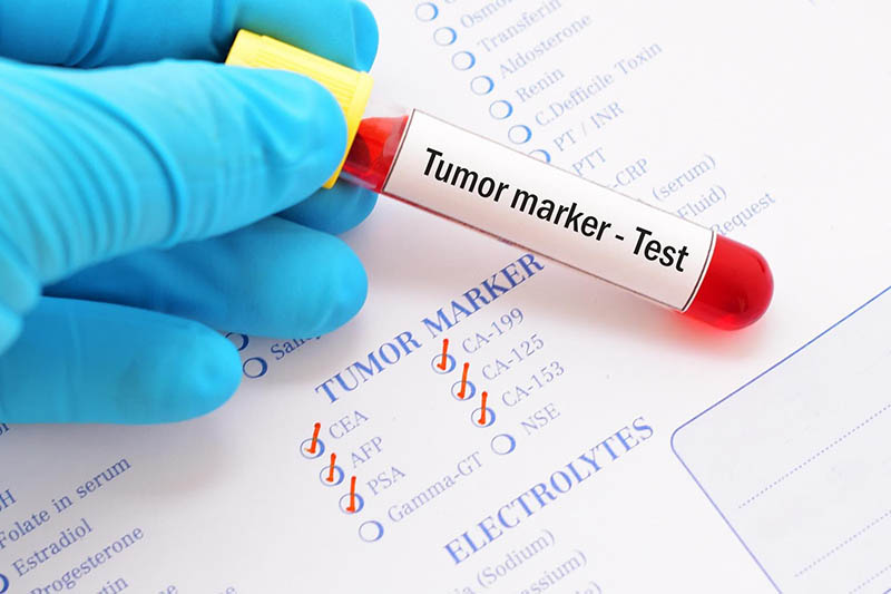 Các marker ung thư giúp chẩn đoán và theo dõi quá trình điều trị