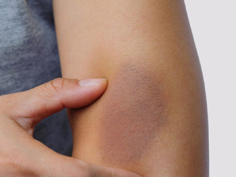 Nếu thấy cơ thể xuất hiện nhiều vết bầm tím bạn cần chú ý