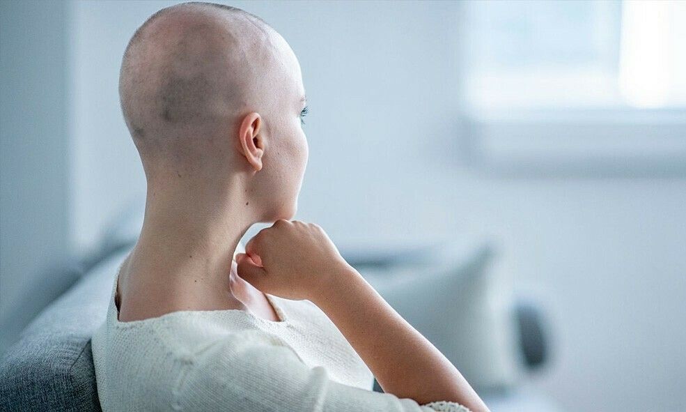 Rụng tóc là dấu hiệu rõ ràng của bệnh nhân đang trong quá trình xạ trị