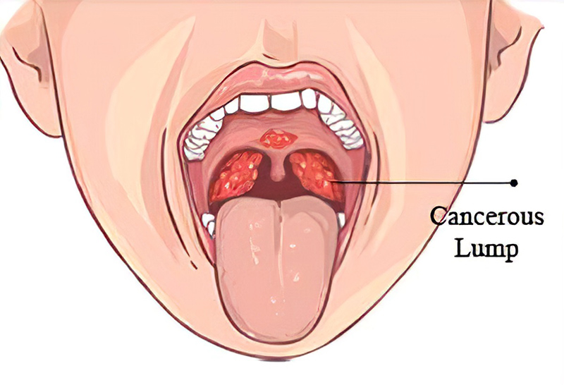 Ung thư vòm hầu xảy ra ở vùng mũi hầu, thuộc phần trên hầu và phía sau mũi