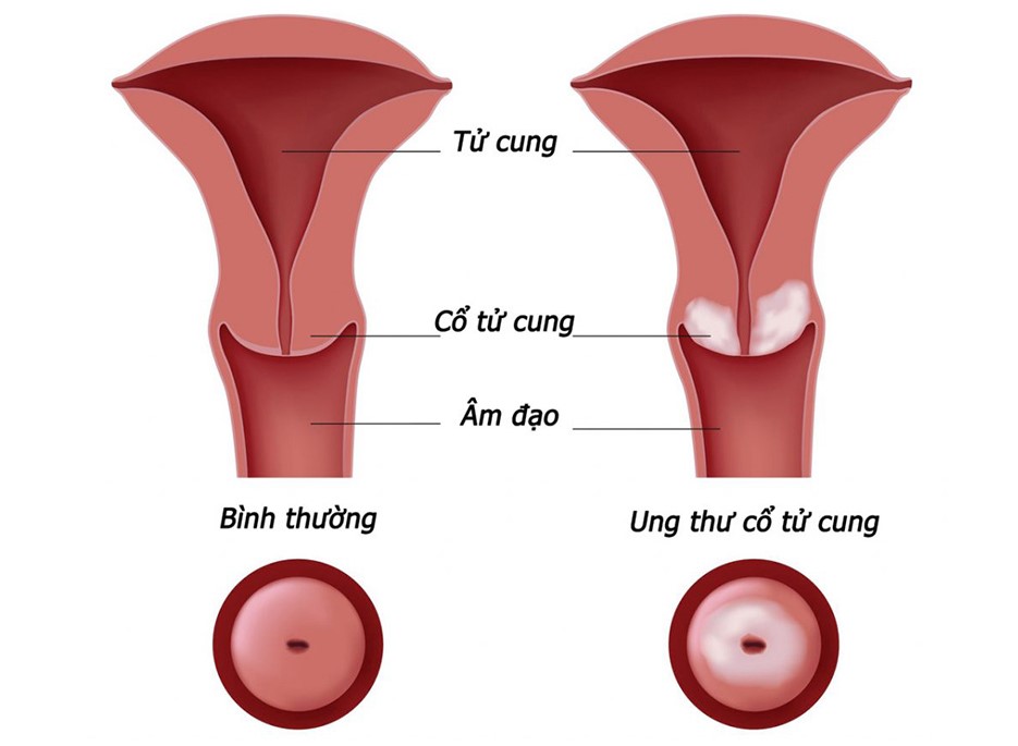 Tử cung thường và tử cung bị ung thư