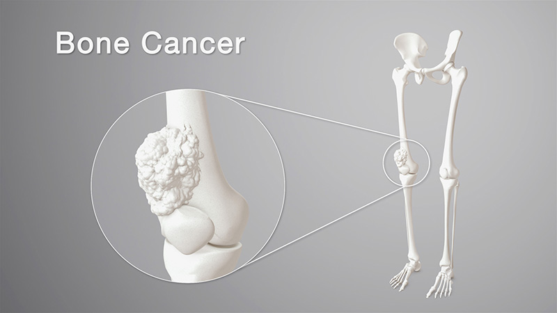 Ung thư sarcoma xương