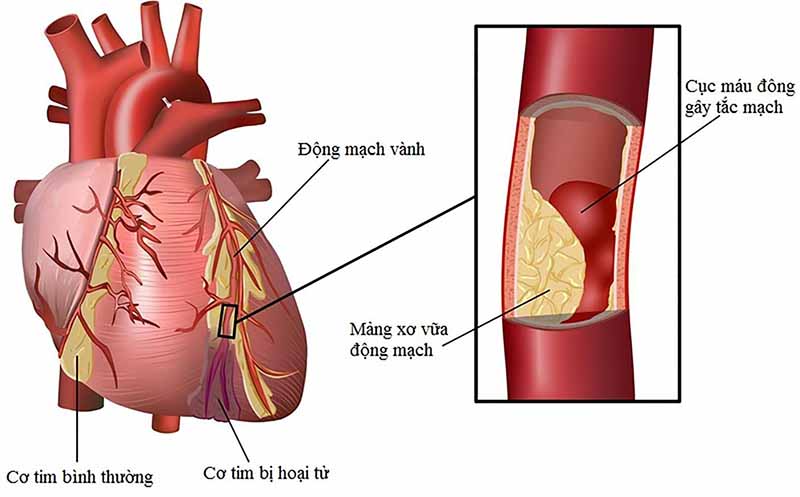 Mỡ máu cao dễ khiến người bệnh dễ mắc các bệnh về tim mạch