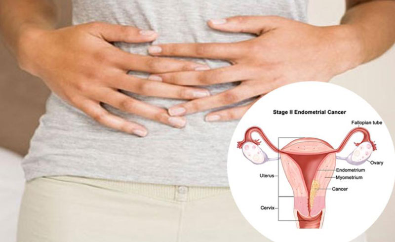 Câu hỏi bệnh ung thư tử cung có chữa được không?