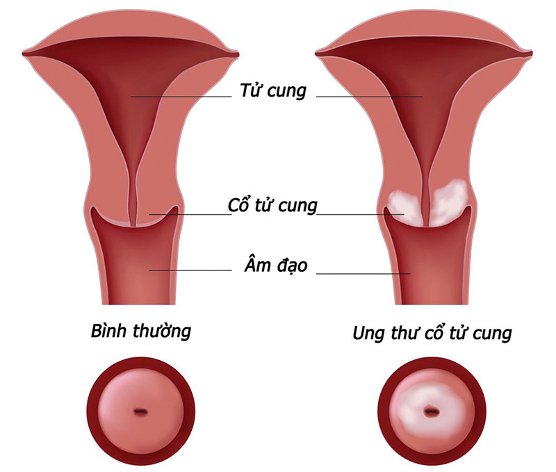 Ung thư cổ tử cung là bệnh xếp hàng đầu về mức độ phổ biến ở nữ giới trên toàn cầu