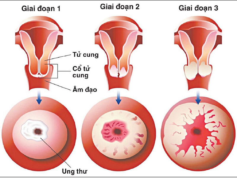 Hình ảnh khối u ung thư cổ tử cung phát triển qua các giai đoạn.