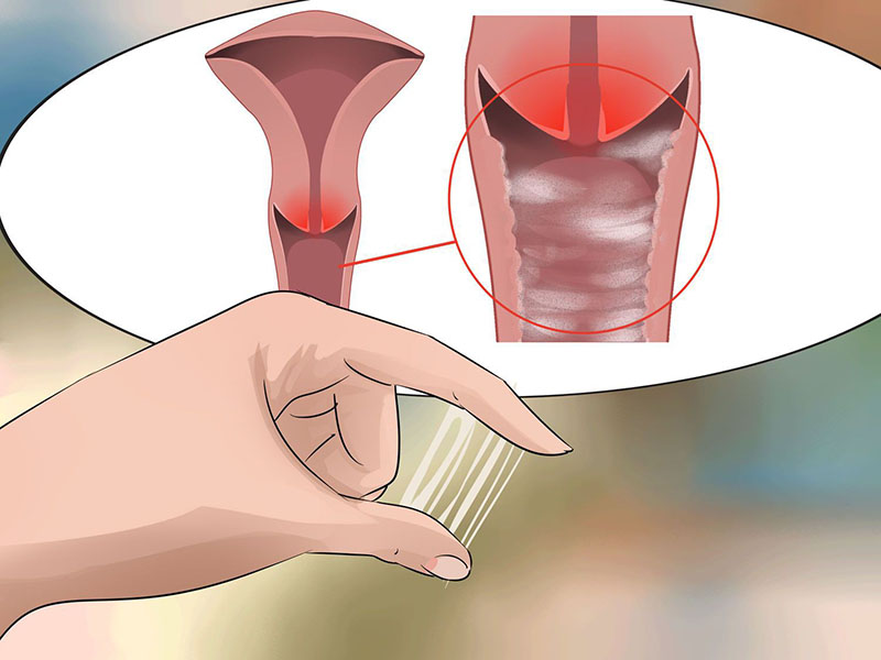 Dịch âm đạo có những thay đổi bất thường có thể là dấu hiệu của ung thư cổ tử cung