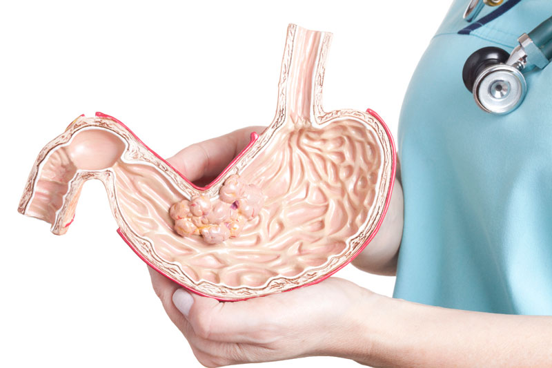 Điều trị ung thư dạ dày bằng phương pháp hóa trị