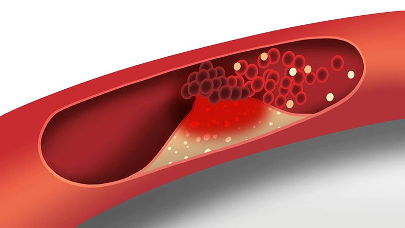 Mỡ máu cao khiến người bệnh dễ mắc các bệnh lý liên quan đến tim mạch