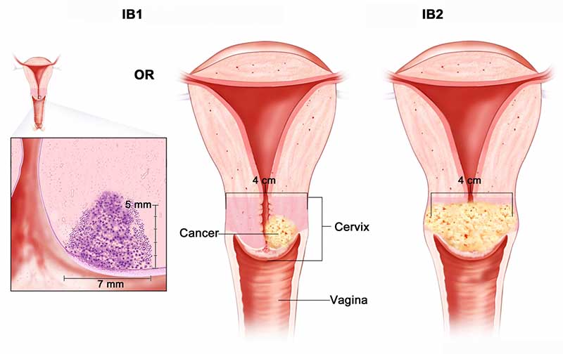 Hình ảnh minh họa ung thư cổ tử cung