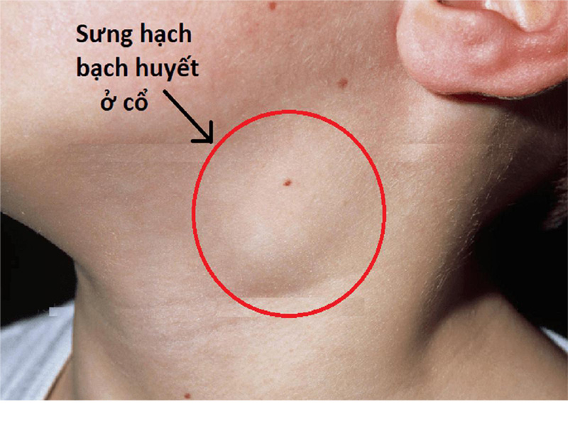 Sưng hạch bạch huyết tại cổ ở bệnh Lymphoma