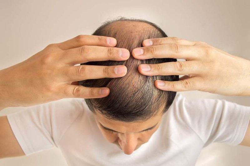 Rụng tóc là một trong những tác dụng phụ thường gặp khi điều trị ung thư