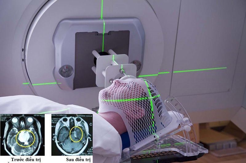 Xạ trị ở một phạm vi lớn trên não có thể khiến người bệnh giảm khả năng nhận thức, mất trí nhớ.