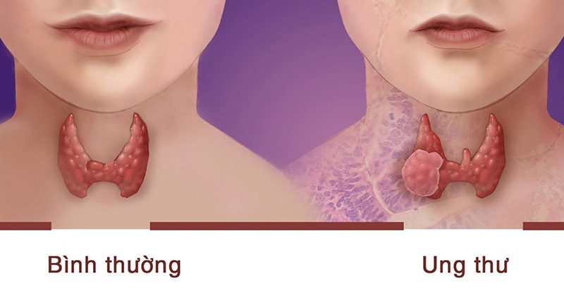 Ung thư tuyến giáp gây nguy hiểm cho cơ thể