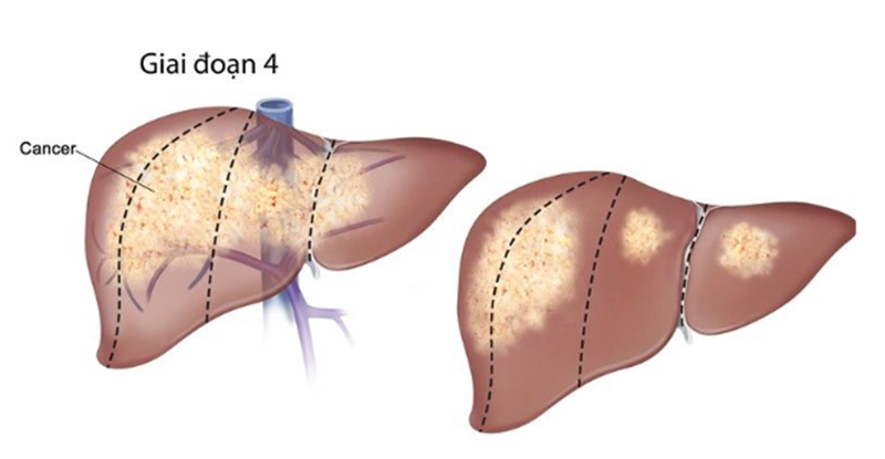Vùng lan rộng trong gan của các tế bào ung thư ở giai đoạn 4