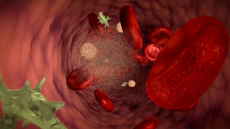 Ung thư máu do tủy và hệ bạch huyết bị rối loạn làm sản sinh bạch cầu ác tính