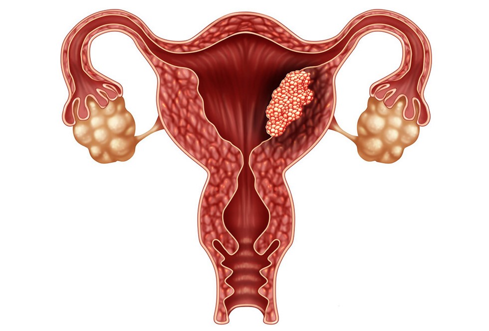 Ung thư nội mạc tử cung là căn bệnh dễ gặp ở nữ giới
