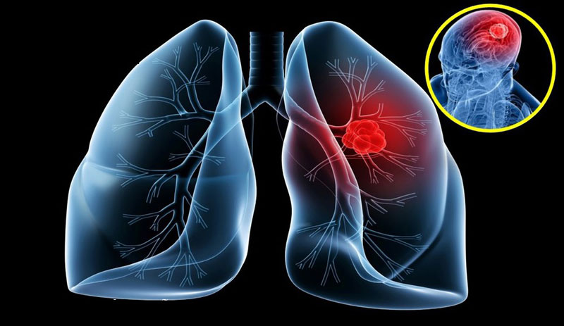 Ung thư phổi di căn não là một trong những biến chứng
