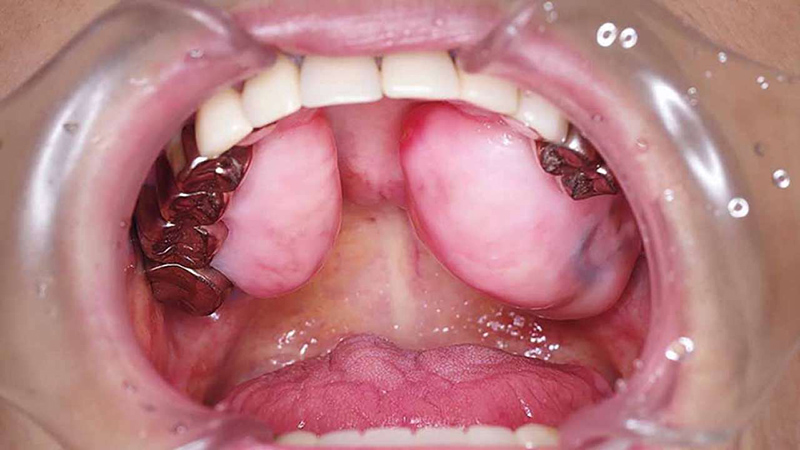 Ung thư ở răng để lại nhiều hậu quả nghiêm trọng, có quá trình phát triển và di căn nhanh chóng