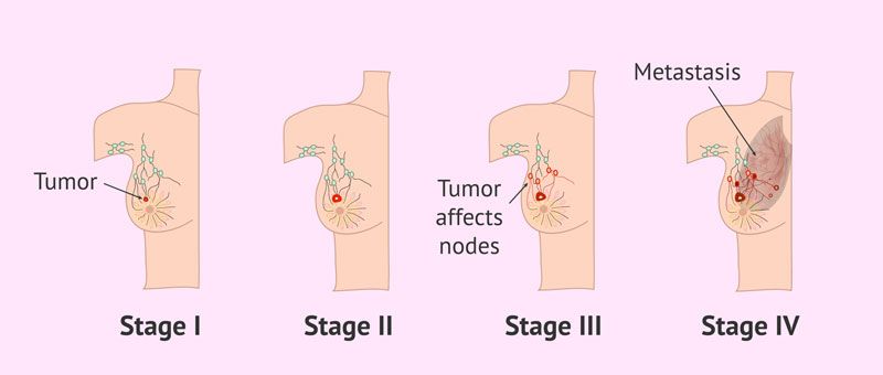 Ung thư vú giai đoạn 2 có dấu hiệu xâm lấn và khối u phát triển mạnh