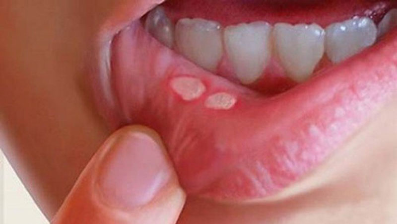 Viêm niêm mạc miệng là một trong những tác dụng phụ của hóa trị ung thư