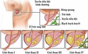 Ung thư tuyến tiền liệt nên ăn gì?