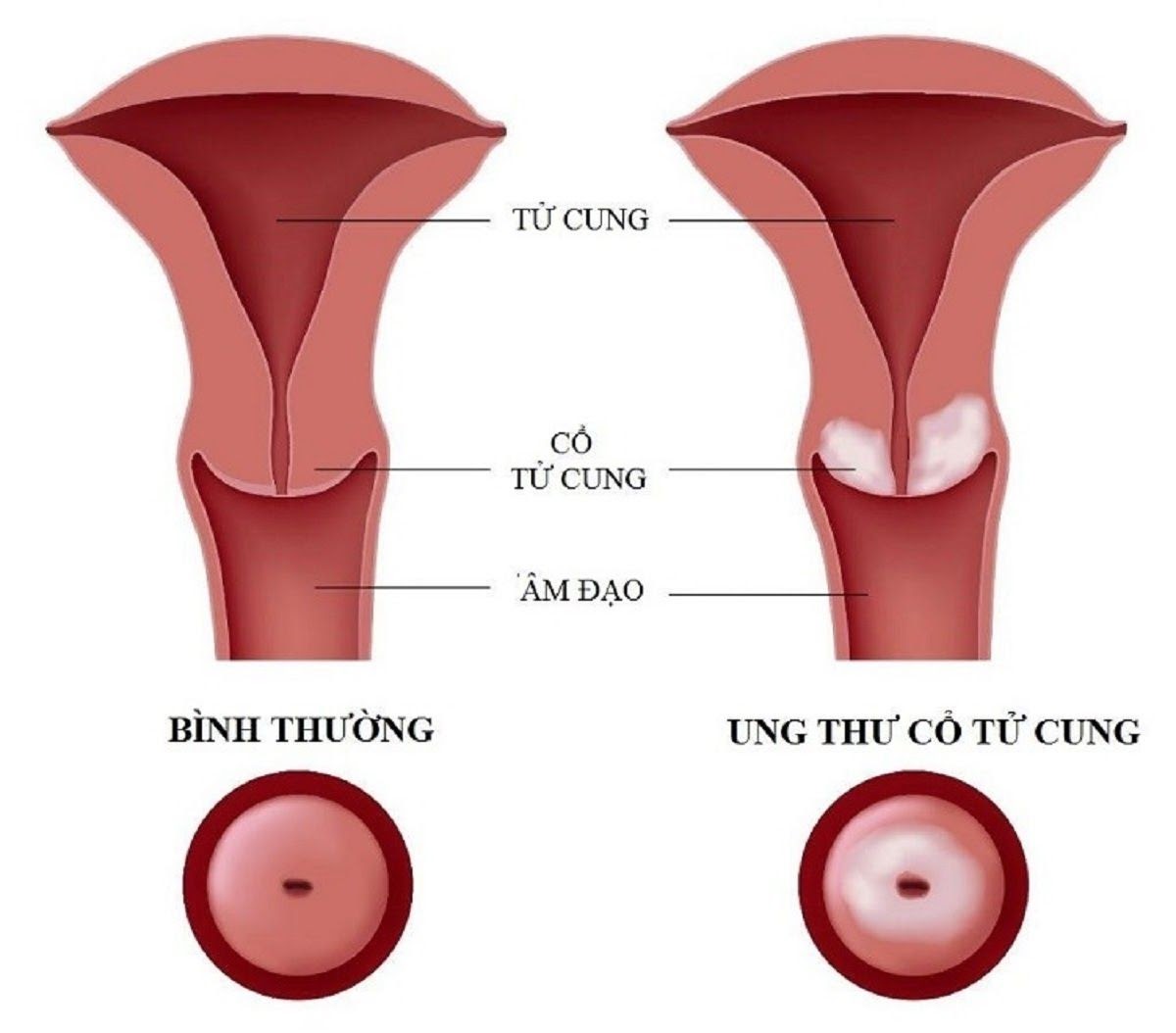 bieu-hien-ung-thu-co-tu-cung1