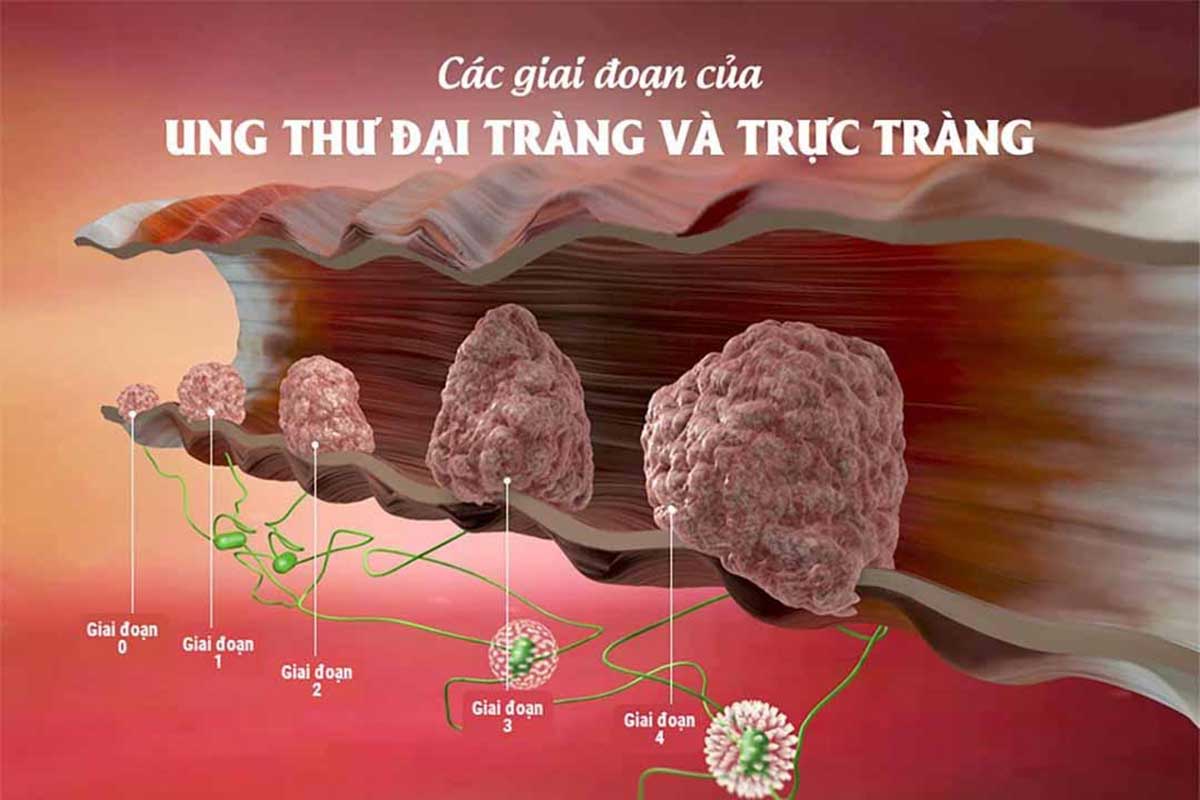 dấu-hiệu-ung-thư-đại-trực-tràng_1